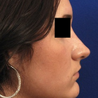 Compare Before & After Photos of _procedure_photos.phpRhinoplasty