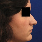 Compare Before & After Photos of _procedure_photos.phpRhinoplasty