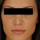 Compare Before & After Photos of _procedure_photos.phpRhinoplasty