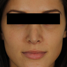 Compare Before & After Photos of _procedure_photos.phpRhinoplasty
