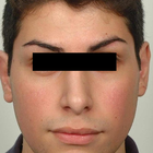 Compare Before & After Photos of _procedure_photos.phpRhinoplasty