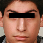 Compare Before & After Photos of _procedure_photos.phpRhinoplasty