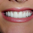 Compare Before & After Photos of _procedure_photos.phpVeneers