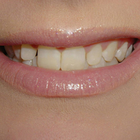 Compare Before & After Photos of _procedure_photos.phpVeneers