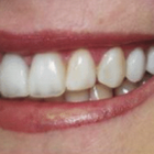 Compare Before & After Photos of _procedure_photos.phpVeneers