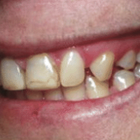 Compare Before & After Photos of _procedure_photos.phpVeneers