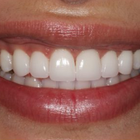 Compare Before & After Photos of _procedure_photos.phpVeneers