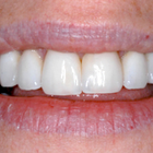 Compare Before & After Photos of _procedure_photos.phpVeneers