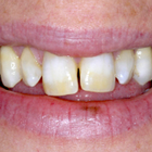 Compare Before & After Photos of _procedure_photos.phpVeneers