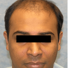 Compare Before & After Photos of _procedure_photos.phpHair Transplant