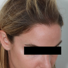 Compare Before & After Photos of _procedure_photos.phpHair Transplant