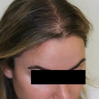 Compare Before & After Photos of _procedure_photos.phpHair Transplant