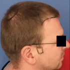 Compare Before & After Photos of _procedure_photos.phpHair Transplant