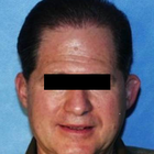 Compare Before & After Photos of _procedure_photos.phpHair Transplant