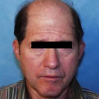 Compare Before & After Photos of _procedure_photos.phpHair Transplant
