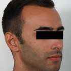 Compare Before & After Photos of _procedure_photos.phpHair Transplant