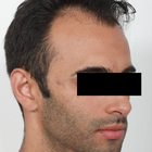 Compare Before & After Photos of _procedure_photos.phpHair Transplant