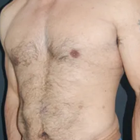 Compare Before & After Photos of _procedure_photos.phpLiposuction