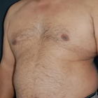 Compare Before & After Photos of _procedure_photos.phpLiposuction