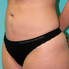 Compare Before & After Photos of _procedure_photos.phpLiposuction