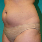 Compare Before & After Photos of _procedure_photos.phpLiposuction