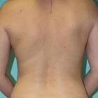 Compare Before & After Photos of _procedure_photos.phpLiposuction