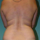 Compare Before & After Photos of _procedure_photos.phpLiposuction