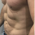 Compare Before & After Photos of _procedure_photos.phpLiposuction