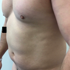 Compare Before & After Photos of _procedure_photos.phpLiposuction