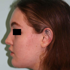 Compare Before & After Photos of _procedure_photos.phpLiposuction