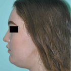 Compare Before & After Photos of _procedure_photos.phpLiposuction