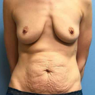 Compare Before & After Photos of _procedure_photos.phpLiposuction