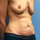 Compare Before & After Photos of _procedure_photos.phpLiposuction