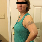 Compare Before & After Photos of _procedure_photos.phpGastric Sleeve