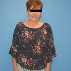 Compare Before & After Photos of _procedure_photos.phpGastric Sleeve