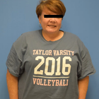 Compare Before & After Photos of _procedure_photos.phpGastric Sleeve