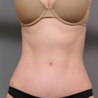 Compare Before & After Photos of _procedure_photos.phpTummy Tuck