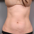 10 Best Clinics For Tummy Tuck In Malaysia 2021 Prices