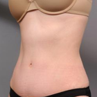 Compare Before & After Photos of _procedure_photos.phpTummy Tuck