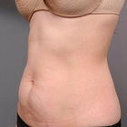 Compare Before & After Photos of _procedure_photos.phpTummy Tuck