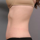 Compare Before & After Photos of _procedure_photos.phpTummy Tuck