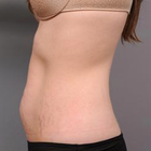 Compare Before & After Photos of _procedure_photos.phpTummy Tuck