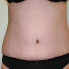 Compare Before & After Photos of _procedure_photos.phpTummy Tuck