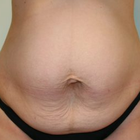 Compare Before & After Photos of _procedure_photos.phpTummy Tuck