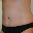 Compare Before & After Photos of _procedure_photos.phpTummy Tuck
