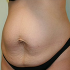 Compare Before & After Photos of _procedure_photos.phpTummy Tuck