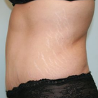 Compare Before & After Photos of _procedure_photos.phpTummy Tuck