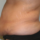Compare Before & After Photos of _procedure_photos.phpTummy Tuck