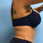 Compare Before & After Photos of _procedure_photos.phpTummy Tuck
