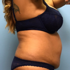 Compare Before & After Photos of _procedure_photos.phpTummy Tuck